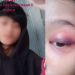 Remaja Perempuan Alami Kekerasan Fisik oleh Mantan Pacar di Cicendo Kota Bandung